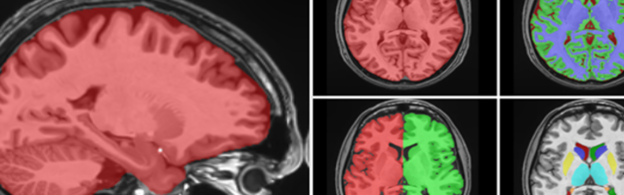 Volbrain Automated Mri Brain Volumetry System 2826